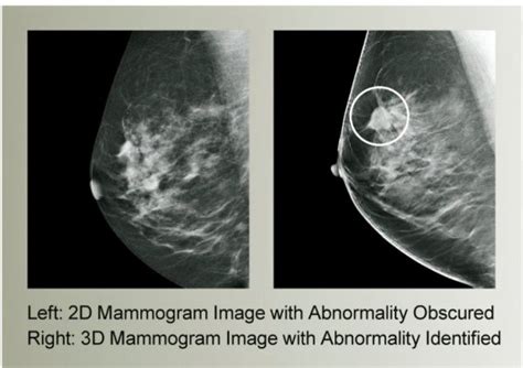 the villages breast imaging|3D Mammography .